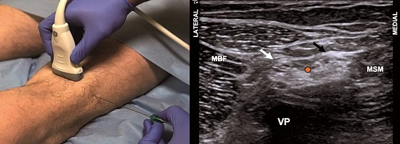 Bloqueo poplíteo ecoguiado para cirugía del pie y tobillo en Sevilla y Huelva, realizado con control por ecografía.