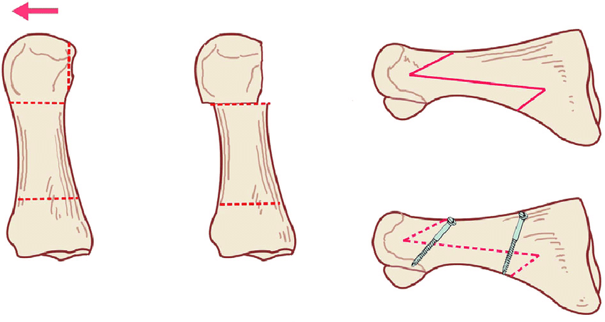 Esquema quirúrgico de osteotomía tipo SCARF para corrección de hallux valgus o juanetes. Técnica abierta con fijación mediante tornillos. Indicada en deformidades moderadas o severas. Cirugía habitual en Sevilla, Huelva y Andalucía.