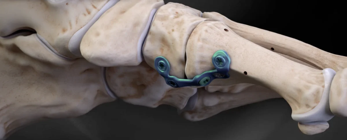 Esquema quirúrgico de artrodesis de Lapidus para el tratamiento del hallux valgus severo con inestabilidad cuneometatarsiana. Técnica de cirugía abierta utilizada en Sevilla, Huelva y otras provincias de Andalucía.