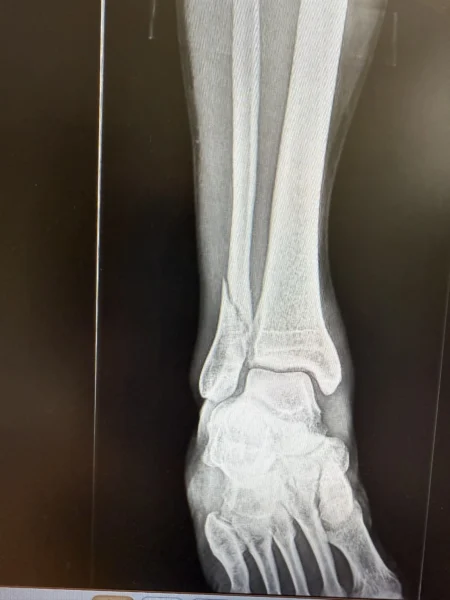 Radiografía anteroposterior de fractura de tobillo con desplazamiento, imagen clínica del Dr. Miguel Ángel Román Cañada, especialista en Sevilla y Huelva.