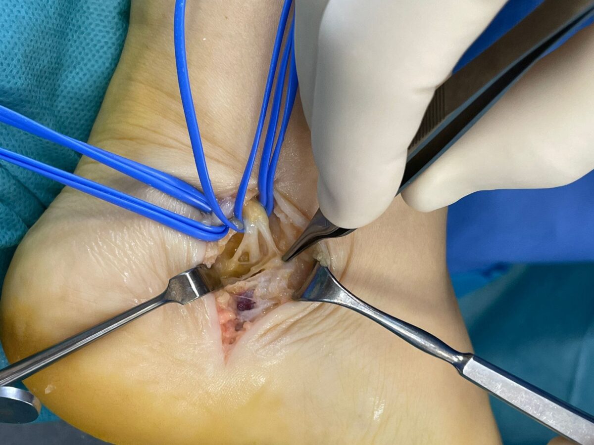 Imagen intraoperatoria de liberación del nervio tibial posterior en el canal tarsiano. Cirugía de descompresión nerviosa realizada en Sevilla para pacientes con atrapamiento del nervio tibial. Técnica empleada también en Huelva y otras zonas de Andalucía.