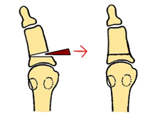 Ilustración quirúrgica de la osteotomía de Akin en la falange proximal del hallux, utilizada como técnica complementaria en la corrección del hallux valgus o juanetes. Cirugía frecuente en Sevilla, Huelva y Andalucía.