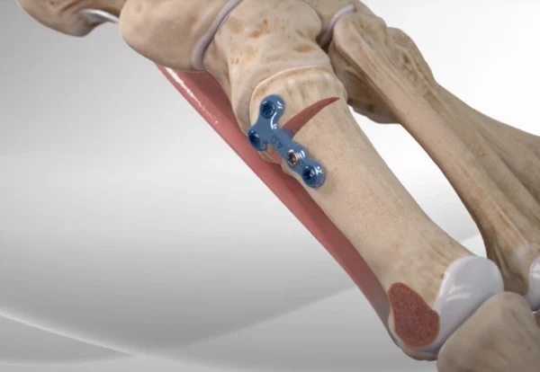 Imagen quirúrgica de osteotomía de apertura en la base del primer metatarsiano, indicada en casos severos de hallux valgus. Técnica de cirugía abierta combinada frecuentemente con Chevron. Aplicada en Sevilla, Huelva y Andalucía.
