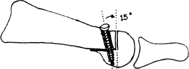 Esquema quirúrgico de osteotomía tipo Chevron en el primer metatarsiano para el tratamiento del hallux valgus o juanetes. Técnica utilizada en cirugía abierta con fijación mediante tornillos. Frecuente en Sevilla, Huelva y Andalucía.