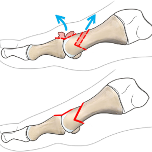 Representación quirúrgica de la osteotomía de Younswick, variante del Chevron con cuña de resección para acortar el primer metatarsiano. Indicada en pacientes con hallux valgus y metatarsalgia. Técnica realizada en Sevilla, Huelva y Andalucía.