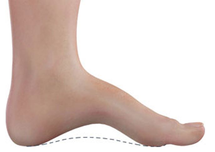 Imagen de un pie cavo con arco plantar elevado, típico de pacientes con deformidad estructural. Clínica del Dr. Román Cañada, especialista en pie y tobillo en Sevilla y Huelva.