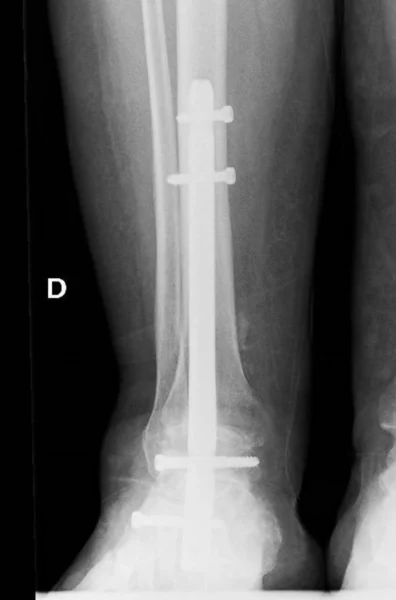 Radiografía anteroposterior mostrando artrodesis del retropié con clavo intramedular