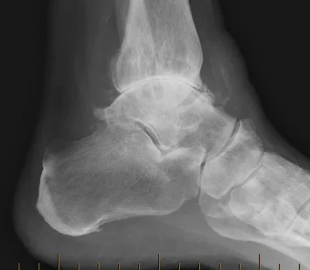 Radiografía lateral de tobillo con artrosis avanzada. Se observa estrechamiento articular y esclerosis subcondral. Imagen clínica habitual en consultas de Sevilla, Huelva y Andalucía.
