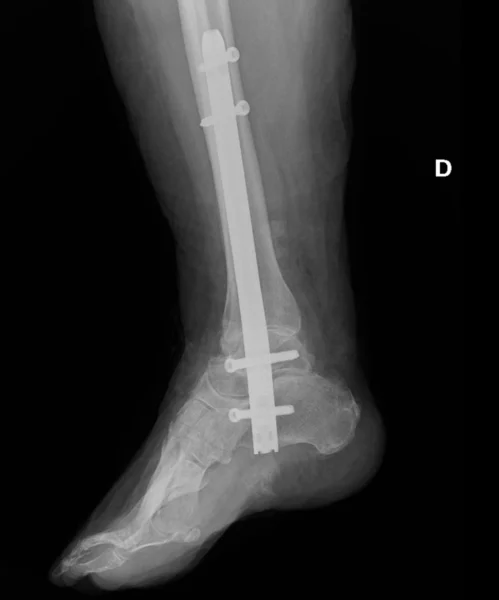 Radiografía lateral de tobillo con artrodesis mediante clavo intramedular