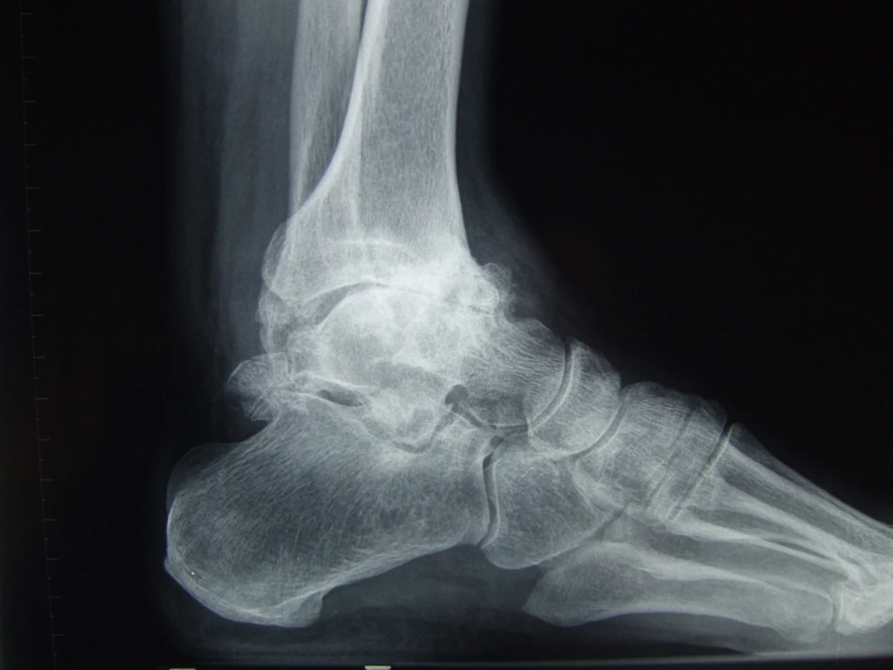Radiografía lateral de tobillo con artrosis tibiotalar avanzada