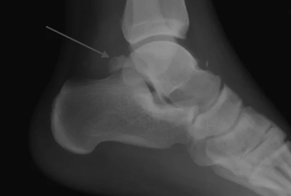 Radiografía lateral de tobillo que muestra un os trigonum, causa frecuente de pinzamiento posterior en pacientes con dolor al extender el pie. Imagen explicativa del Dr. Román Cañada, especialista en Sevilla y Huelva.